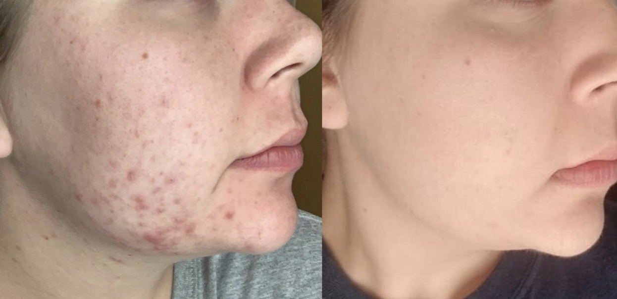 reviewer with visible acne and redness on jawline on the left and visibly less acne on the right