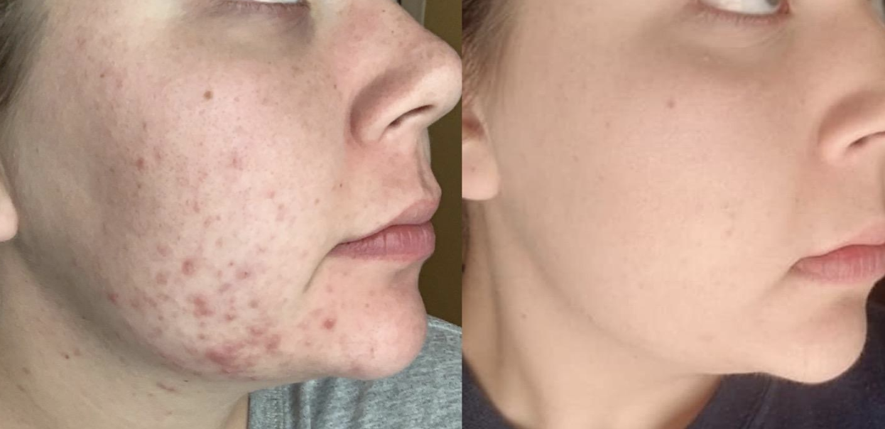 reviewer with visible acne and redness on jawline on the left and visibly less acne on the right