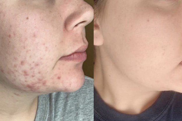 reviewer with visible acne and redness on jawline on the left and visibly less acne on the right