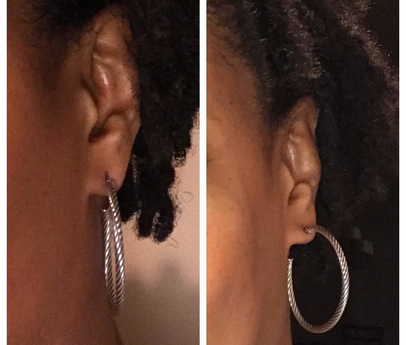 A reviewer image showing their ear with a heavy hoop earring inserted and the piercing hole slightly stretched, and the same ear with the same earing with a lobe patch attached and the piercing hole looking less stretched