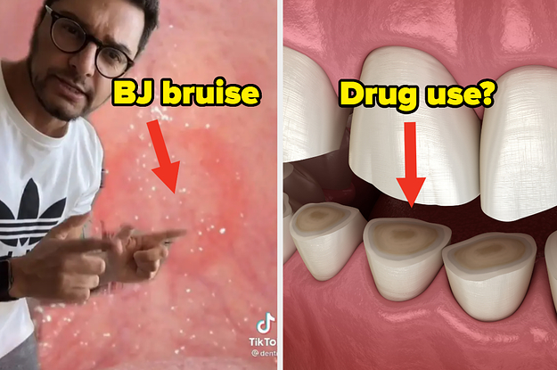 A bruised palate from a blowjob, and dull teeth from drug use