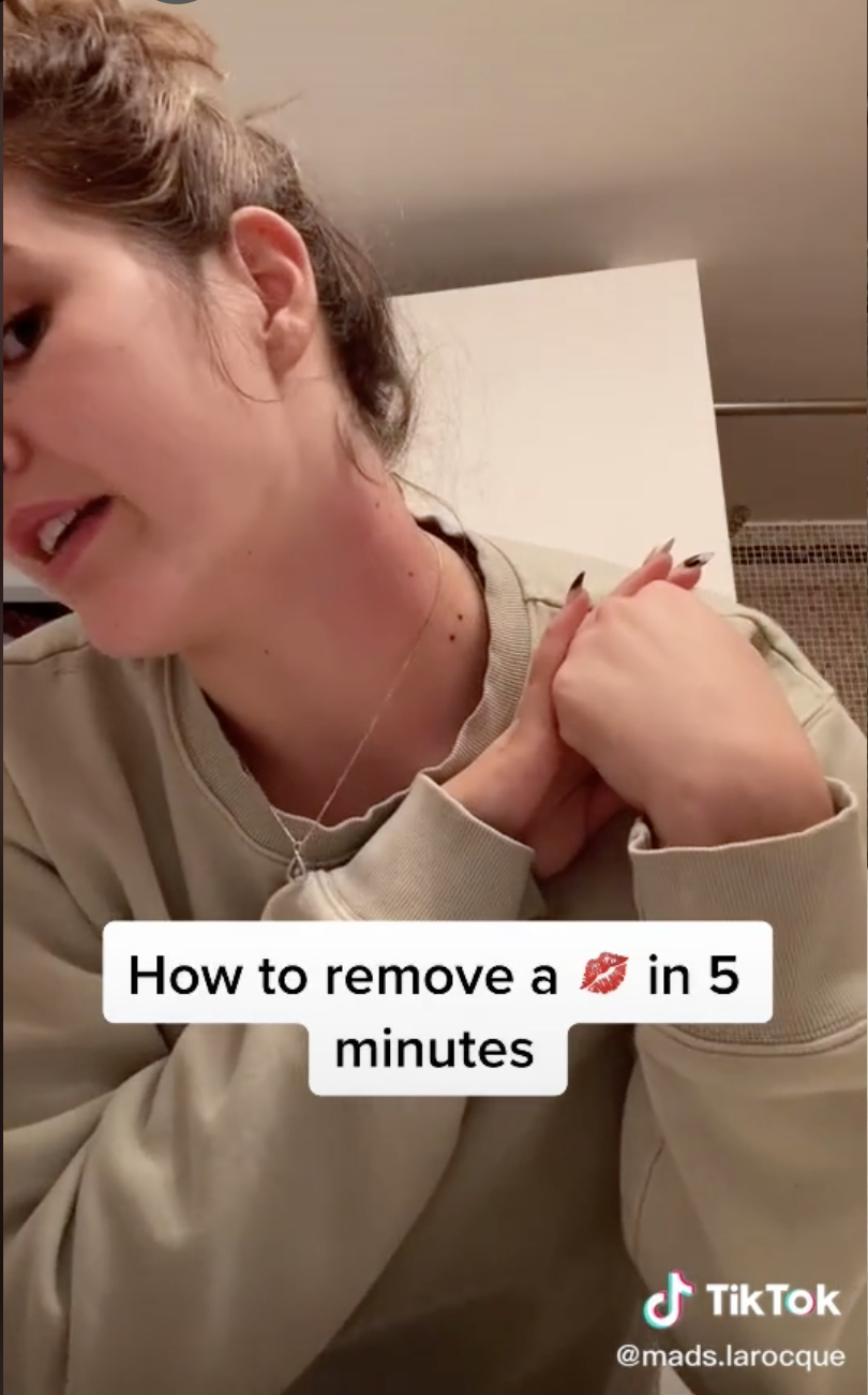 Effective of get way a hickey to rid most 16 Natural
