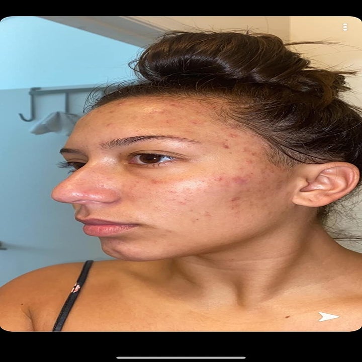 reviewer's face with acne spots