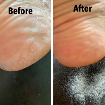 Reviewer's before and after with rough calluses on their heel before that are gone after use 