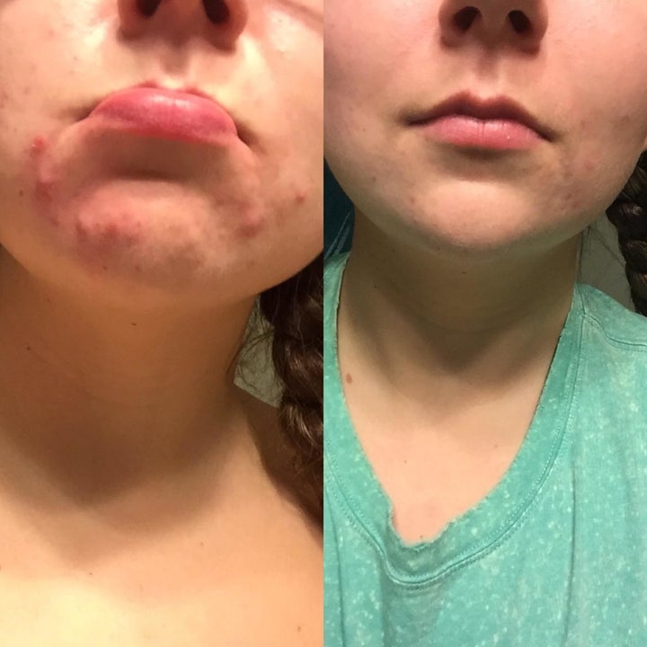 on left, reviewer's chin covered in acne. On right, reviewer's cleared-up chin after using the toner