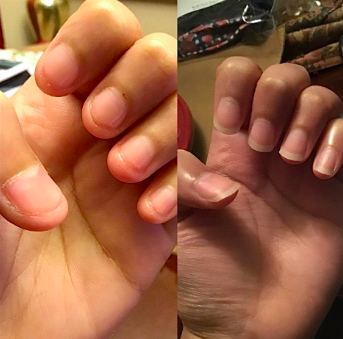 Reviewer before and after with nails bitten to the point of swelling at the fingertips and the nails long and healthy after use 