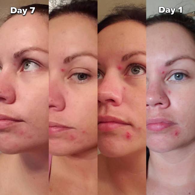 reviewer photo showing four pictures of red pimples gradually fading
