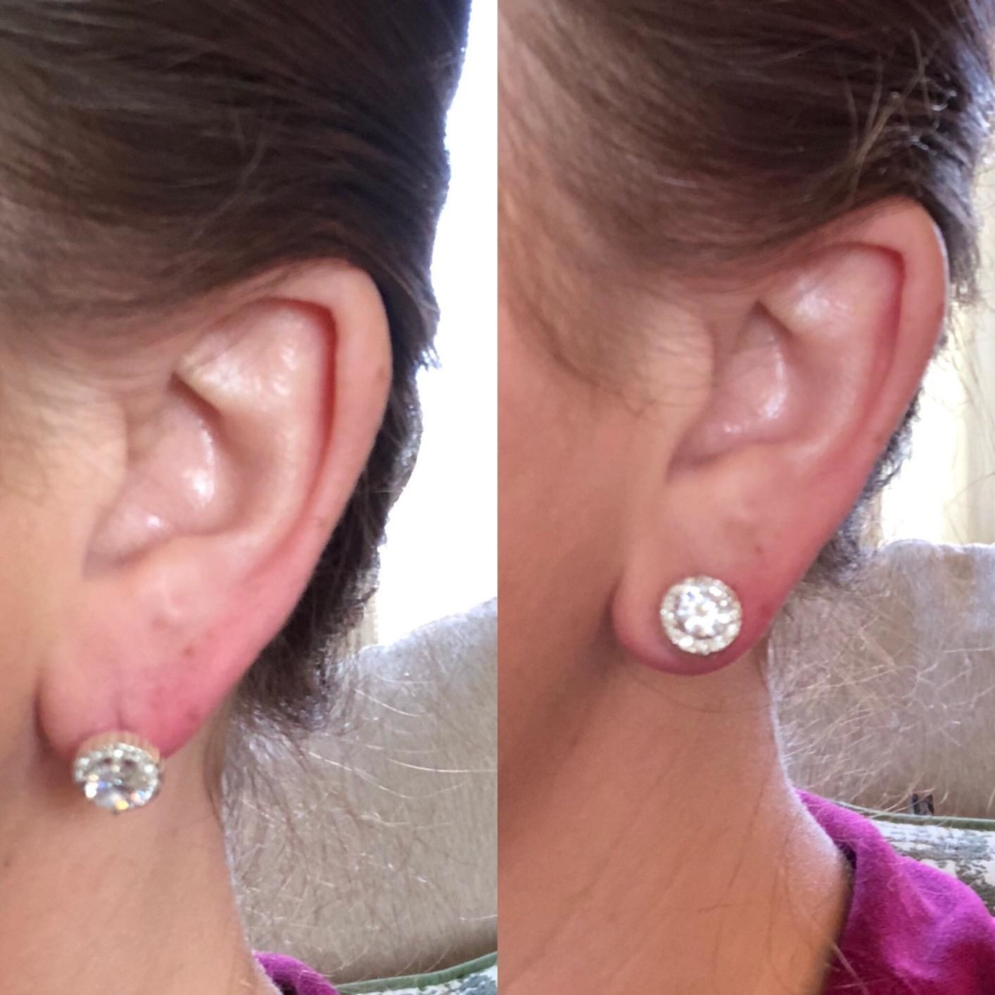 before and after reviewer images: the before shows an earlobe drooping with the weight of a stud earring and the after shows the same earlobe lifted using the magic bax earring lifters