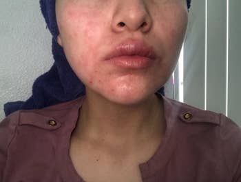 Before photo of reviewer with psoriasis flare-up around their mouth and on their cheeks
