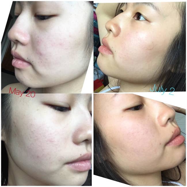 Reviewer's progression photos showing the serum reduced redness and breakouts on their face