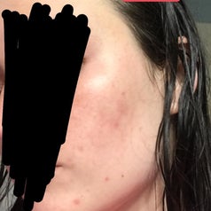 The same reviewer after, with reduced acne and redness