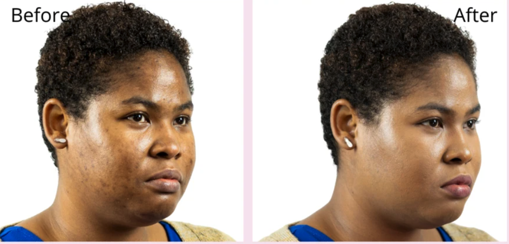before/after of model wearing foundation with after showing smoother skin