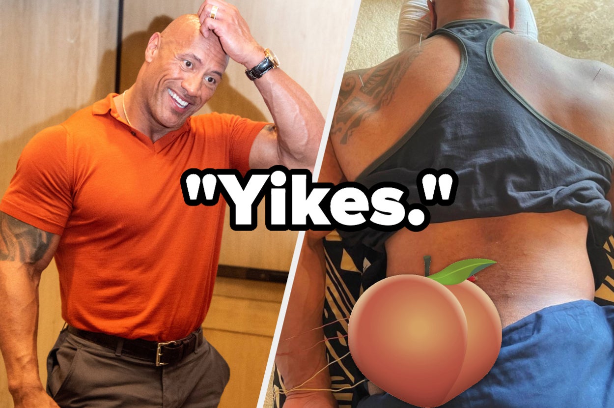 Side by side photos of The Rock scratching his head and getting acupuncture