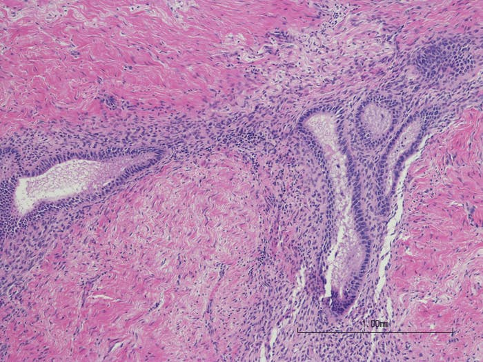 An image of endometriosis lesions 