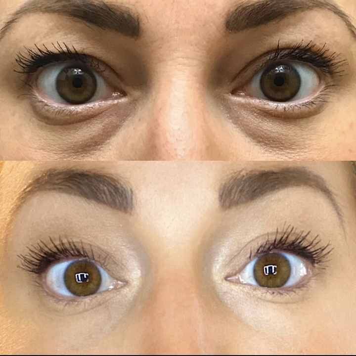 Before and after image of reviewer with dark circles under eyes that are much brighter after use 