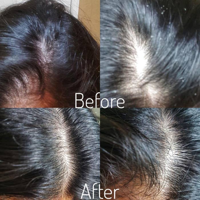 A before and after photo showing that the hair scrub fixed a user's dandruff problems