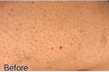 a reviewer photo of their skin with lots of irritated hair follicles and ingrown hairs 