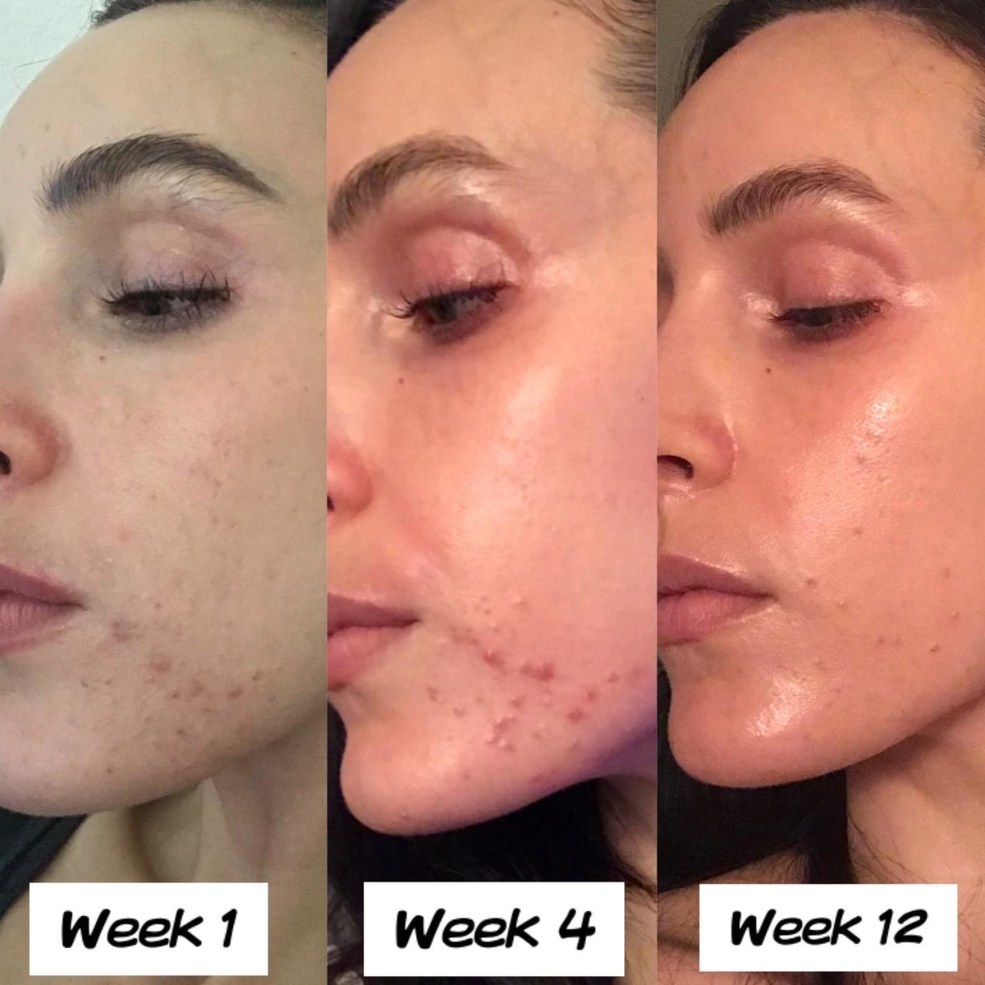 Reviewer photo showing results of using Differin gel over 12 weeks