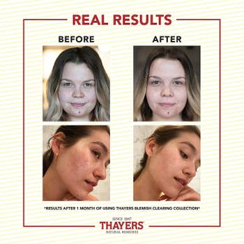 Before-and-after results of using Thayers Blemish Clearing Pads for one month