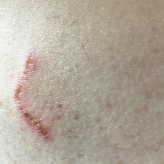 the reviewer's scar during.