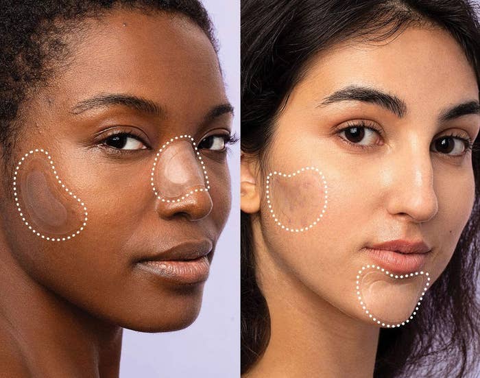 Two people wearing the acne patches