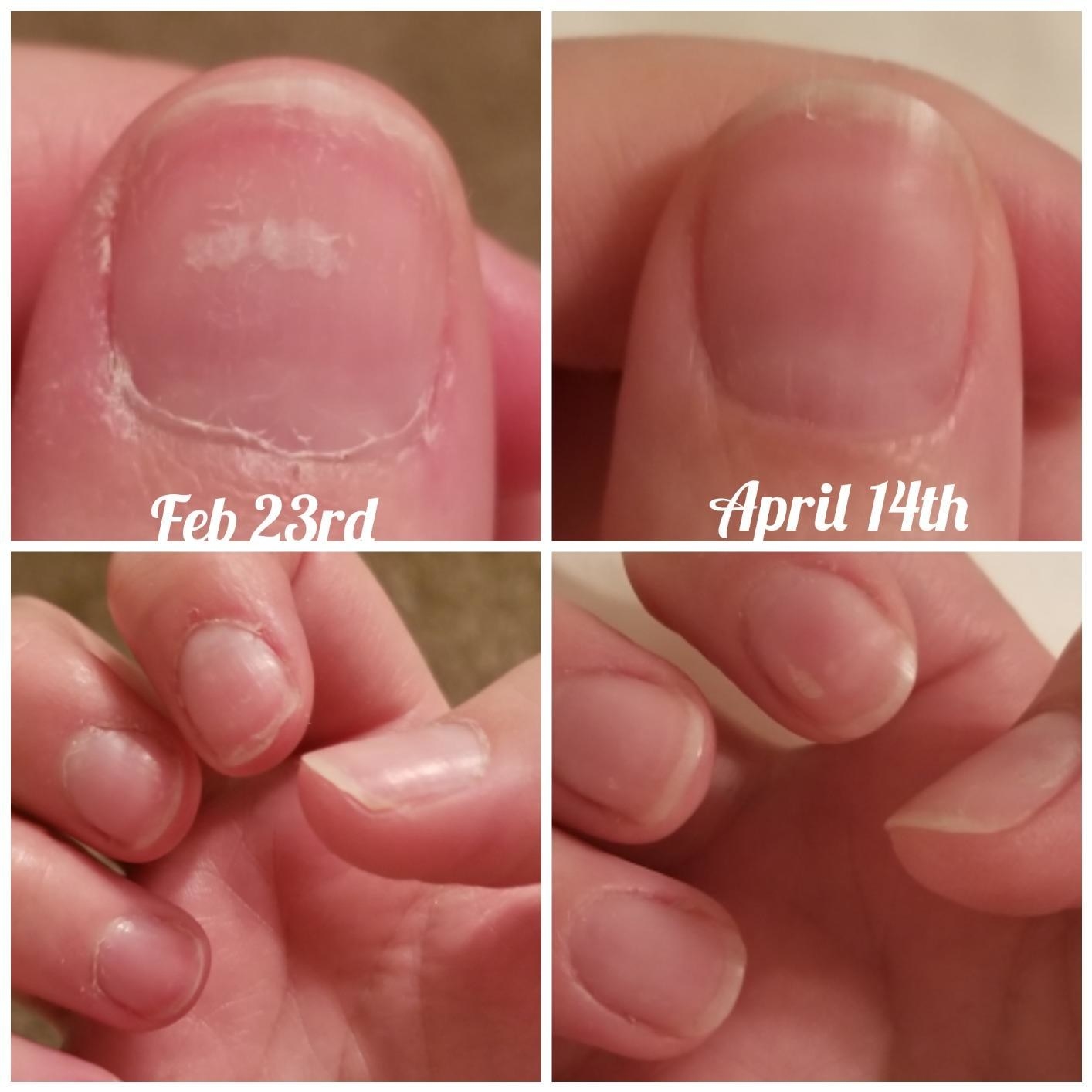reviewer photo showing their nails dry and cracked, and then two weeks later looking perfectly healthy and shiny after using the Cuticle Care