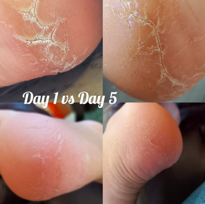 Severely cracked heels on day one that are no longer cracked and only slightly visible by day five 