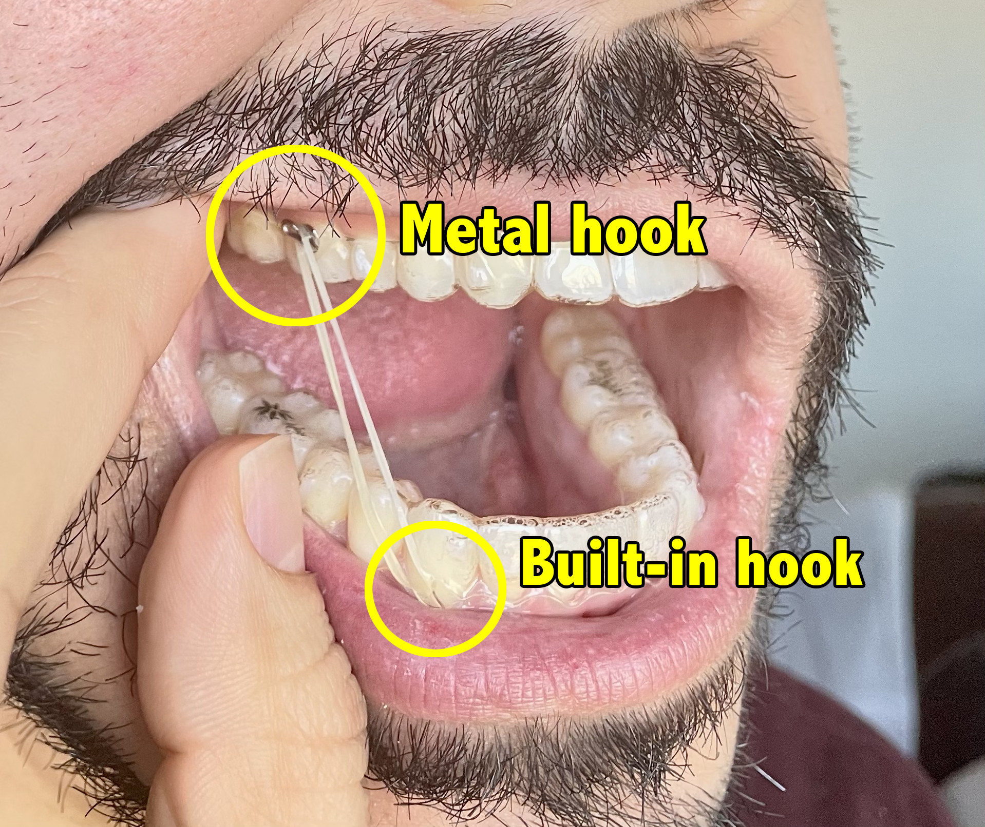 Pablo&#x27;s mouth, which has a rubber band connecting his top and bottom teeth with the use of hooks