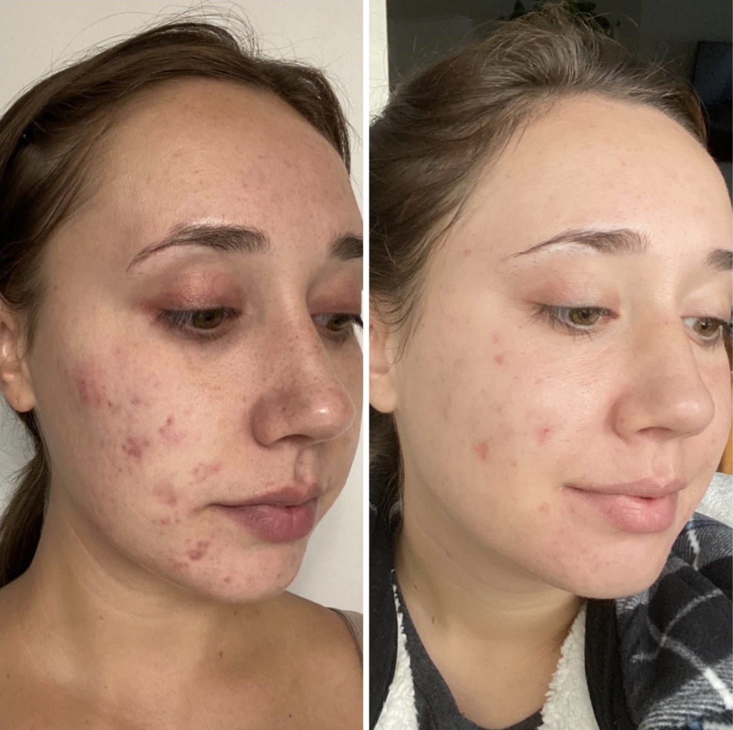 a before and after shot of a person using differing gel for acne