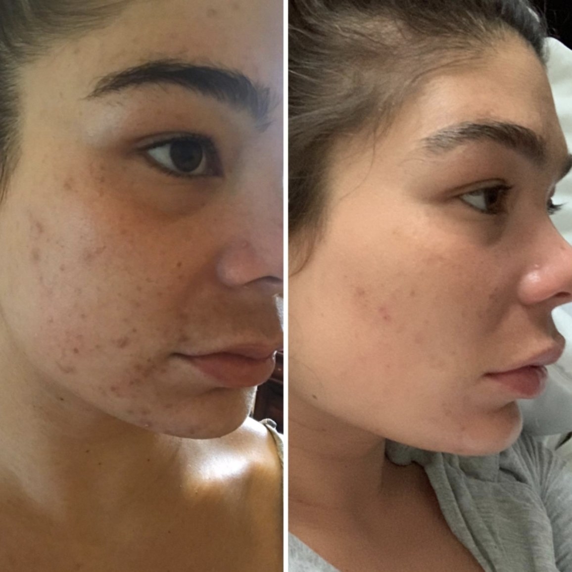 before and after photos of a person with acne