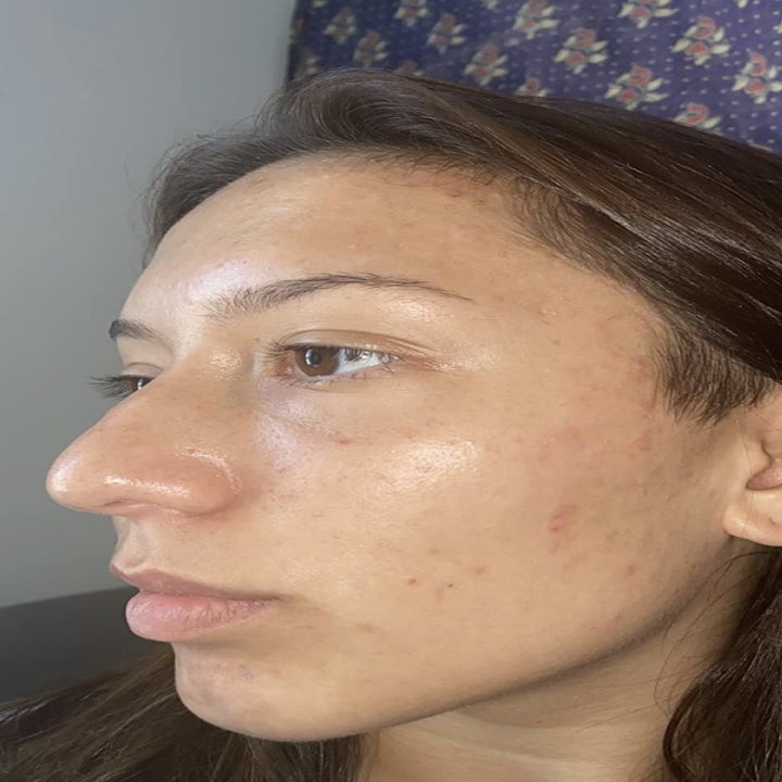a person with clear skin after using this cleanser