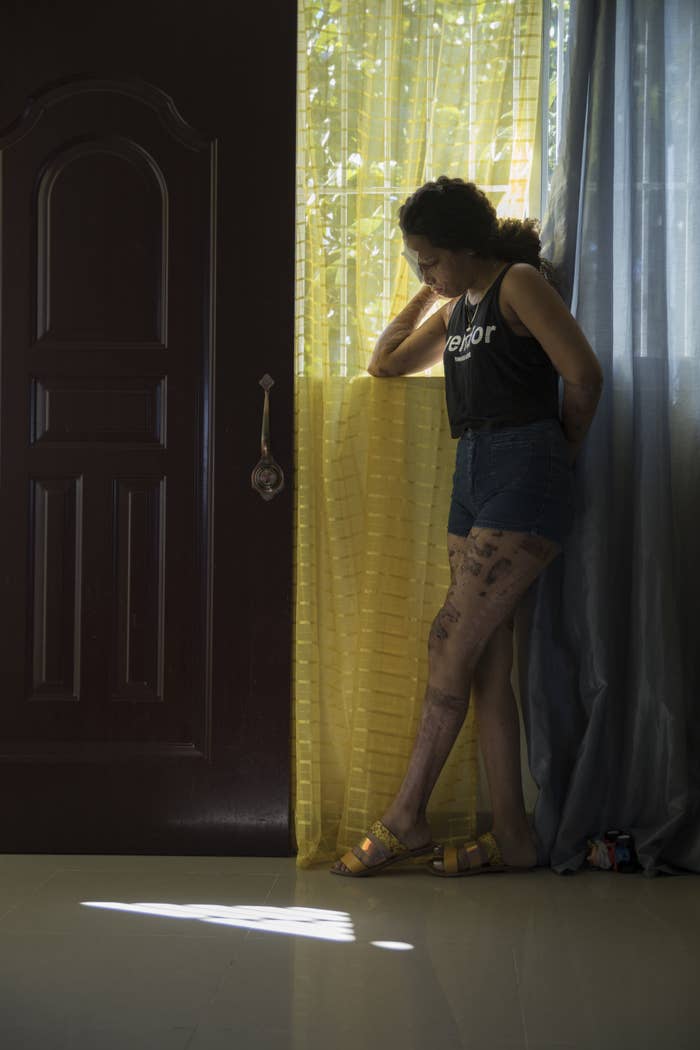 A woman with a bandaged eye and scars on her legs, wearing jean shorts and a tank top, stands by a window