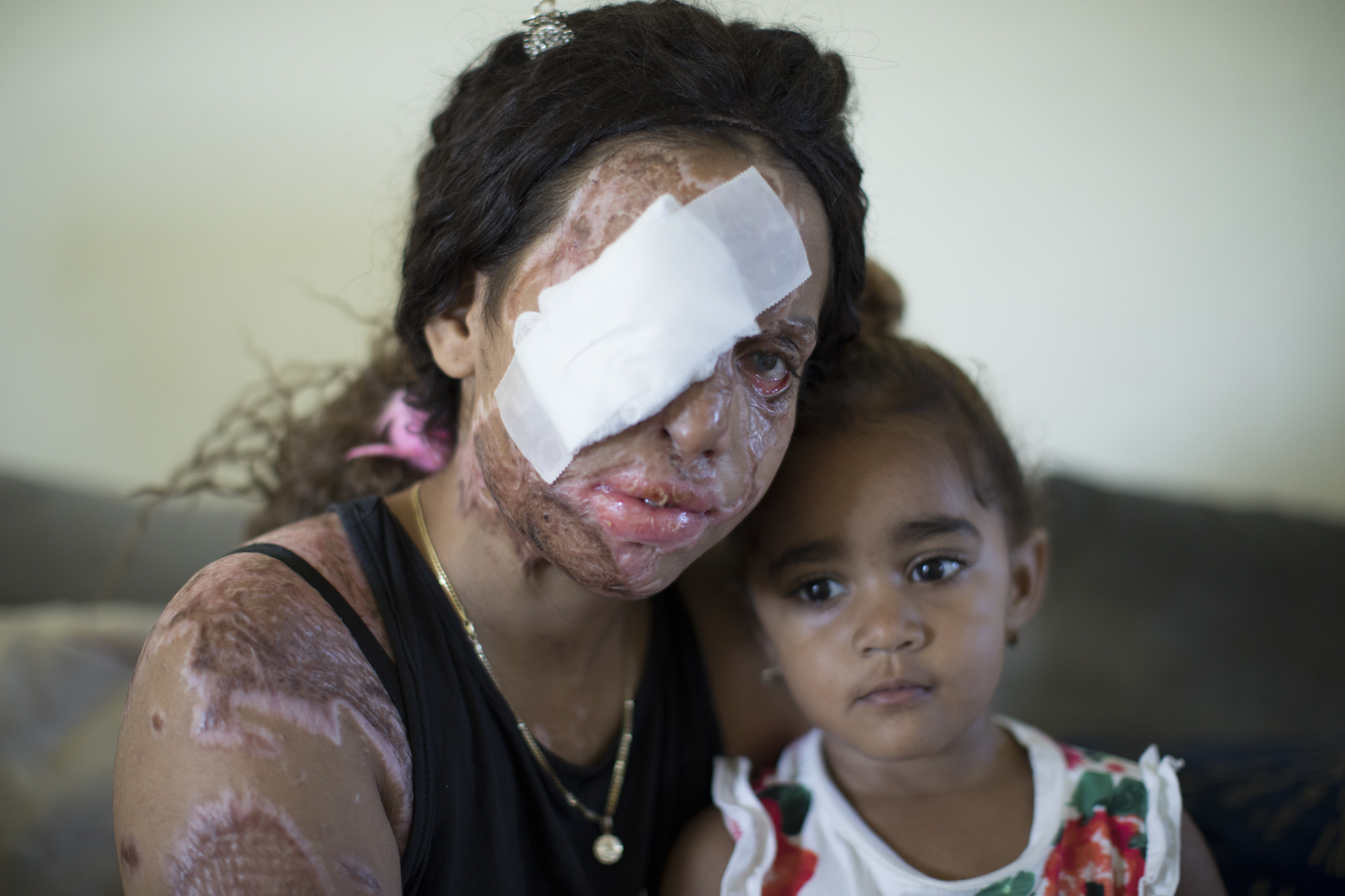 A woman with a bandaged eye and scars on her face and arms sits beside her young daughter