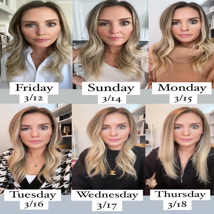 Influencer Whitney Buha Shares Botched Botox On Instagram