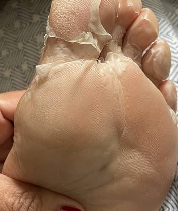 reviewer showing dead skin peeling off their toes