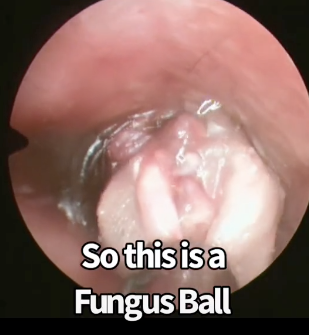 Close up of fungus ball from TikTok