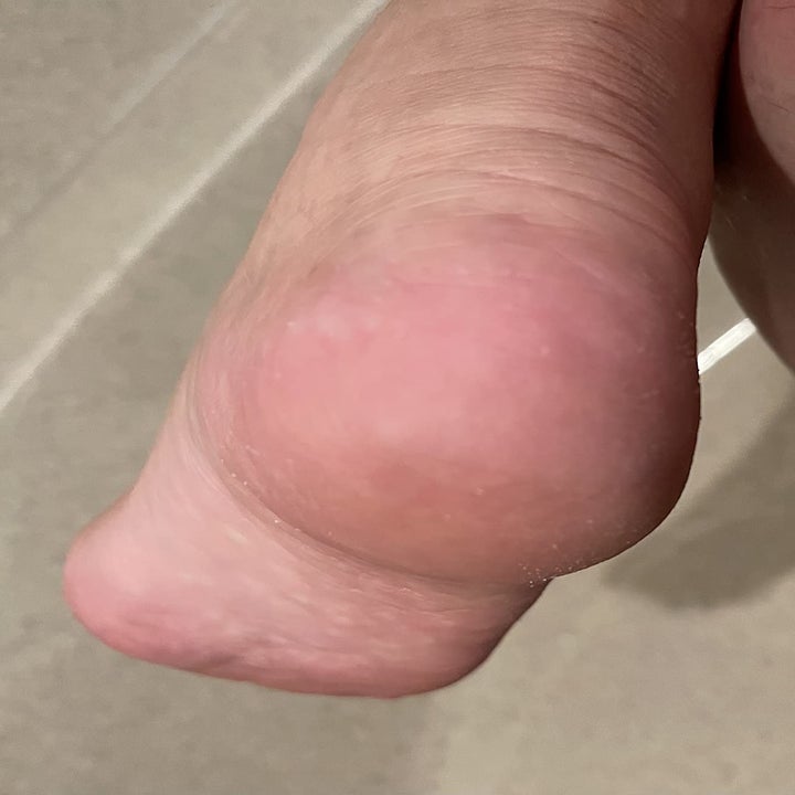 Reviewer photo of foot after using foot file