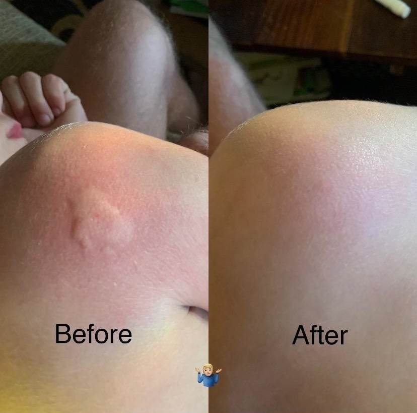reviewer before and after images; in the before image a big mosquito bite bulges from the skin and in the after image, the bite is gone