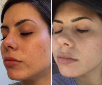 Before and after showing the serum helped get rid of breakouts on reviewer's cheek