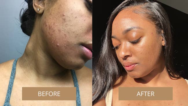 Before and after showing the oil helped get rid of user's red, irritated cheek breakouts