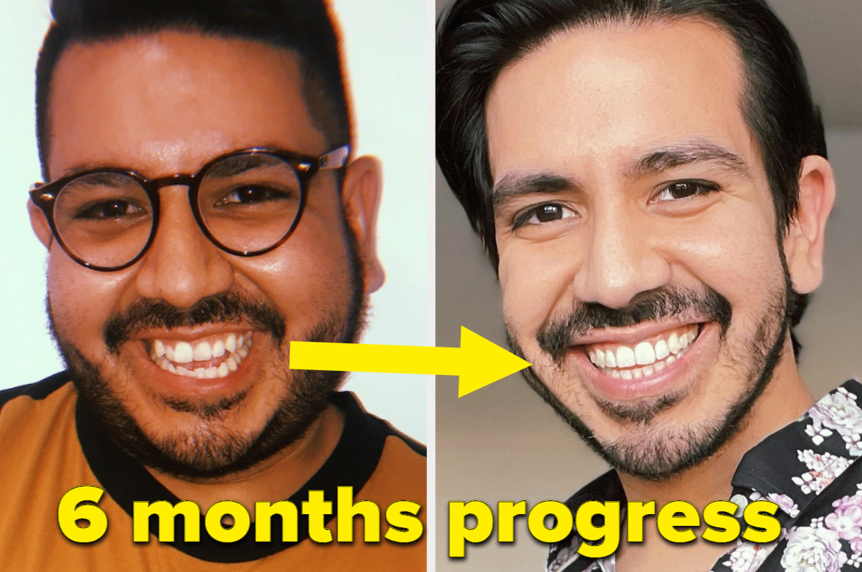 Pablo&#x27;s tooth progress in six months, in which his teeth straightened out