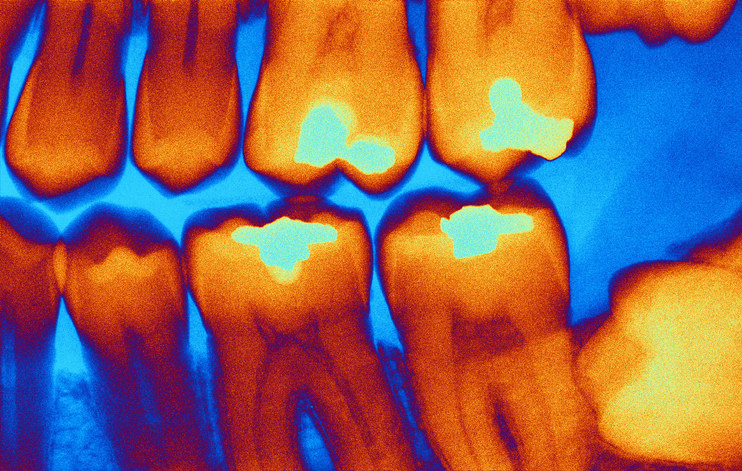An X-ray of teeth with fillings
