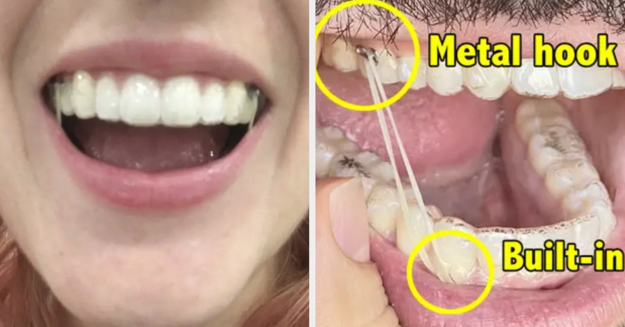 Don't get Invisalign Attachments Before watching this!