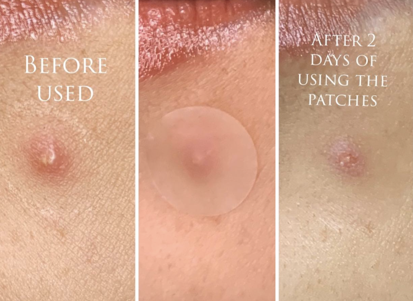 a series of photos showing a reviewer's pimple going down with use of the pimple patch