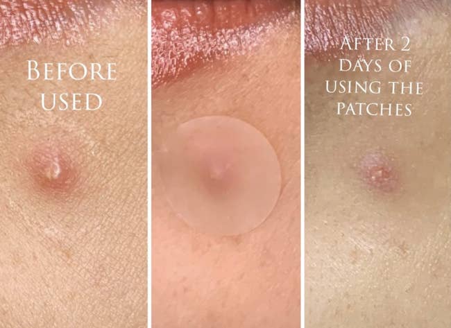 a series showing a reviewer's pimple going down with use of the pimple patch