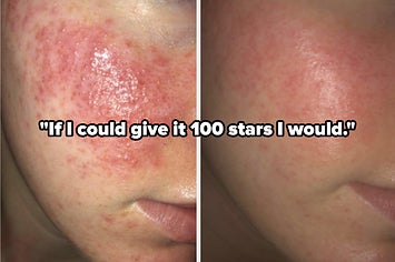 face wash for inflammatory acne