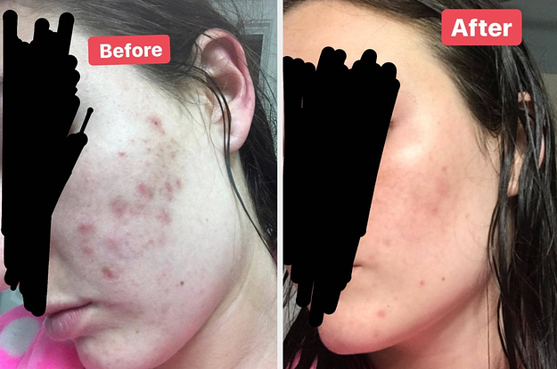 A before/after of a reviewer's cleared up acne