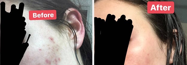 adult acne products