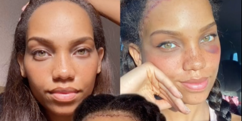 Forehead Reduction Surgery: A Woman On Tiktok's Story