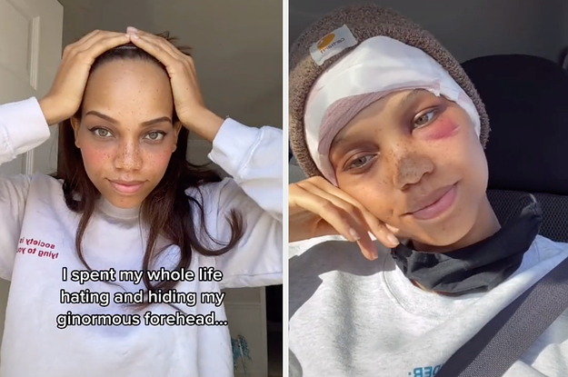 A before and after of the forehead surgery